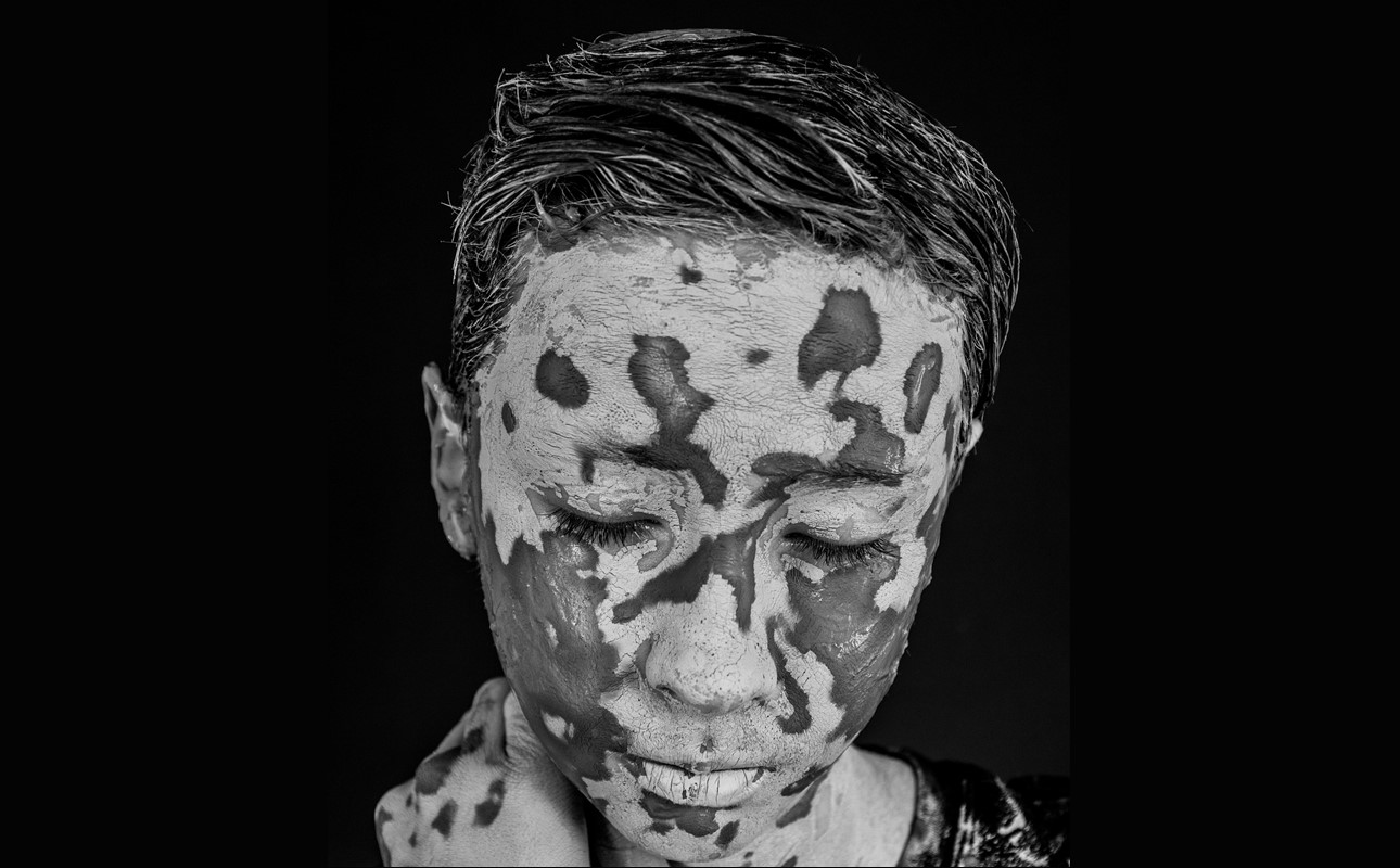 EVERY PIGMENTATION HAS ITS SOLUTION: FROM CLINICAL EVIDENCE TO VISIBLE RESULTS